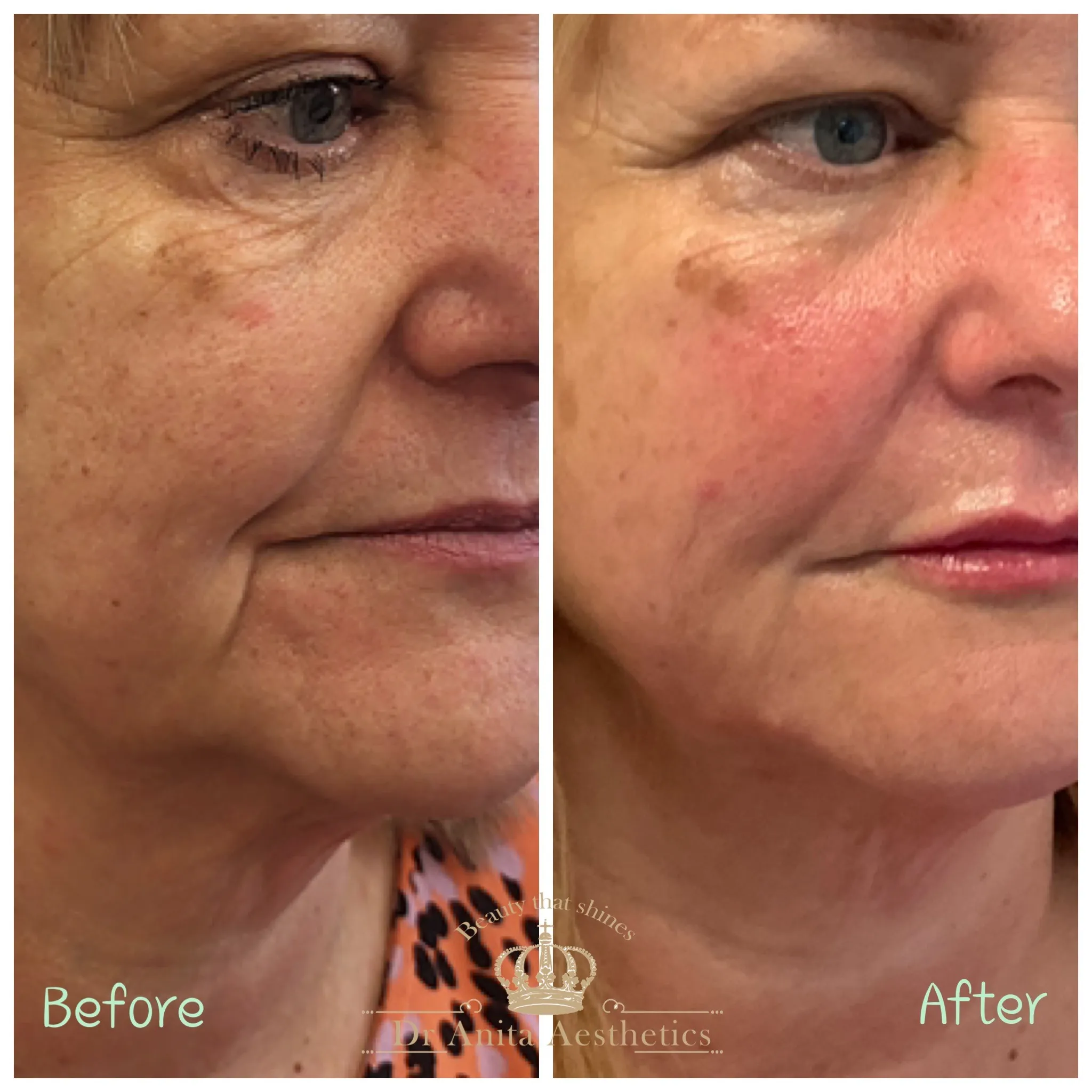 A before and after picture of a woman's face with marionette lines.
