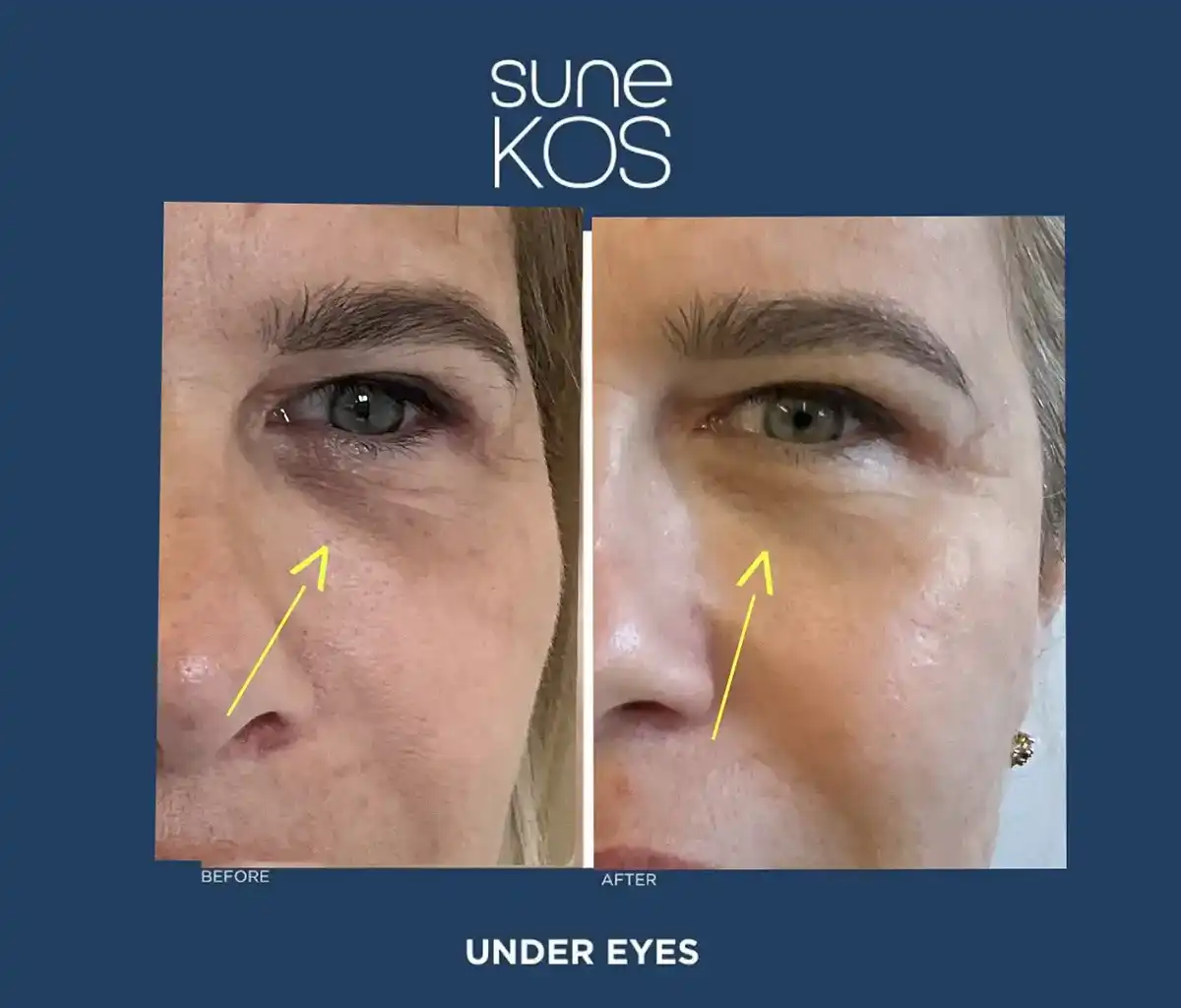 Sunekos under eye
