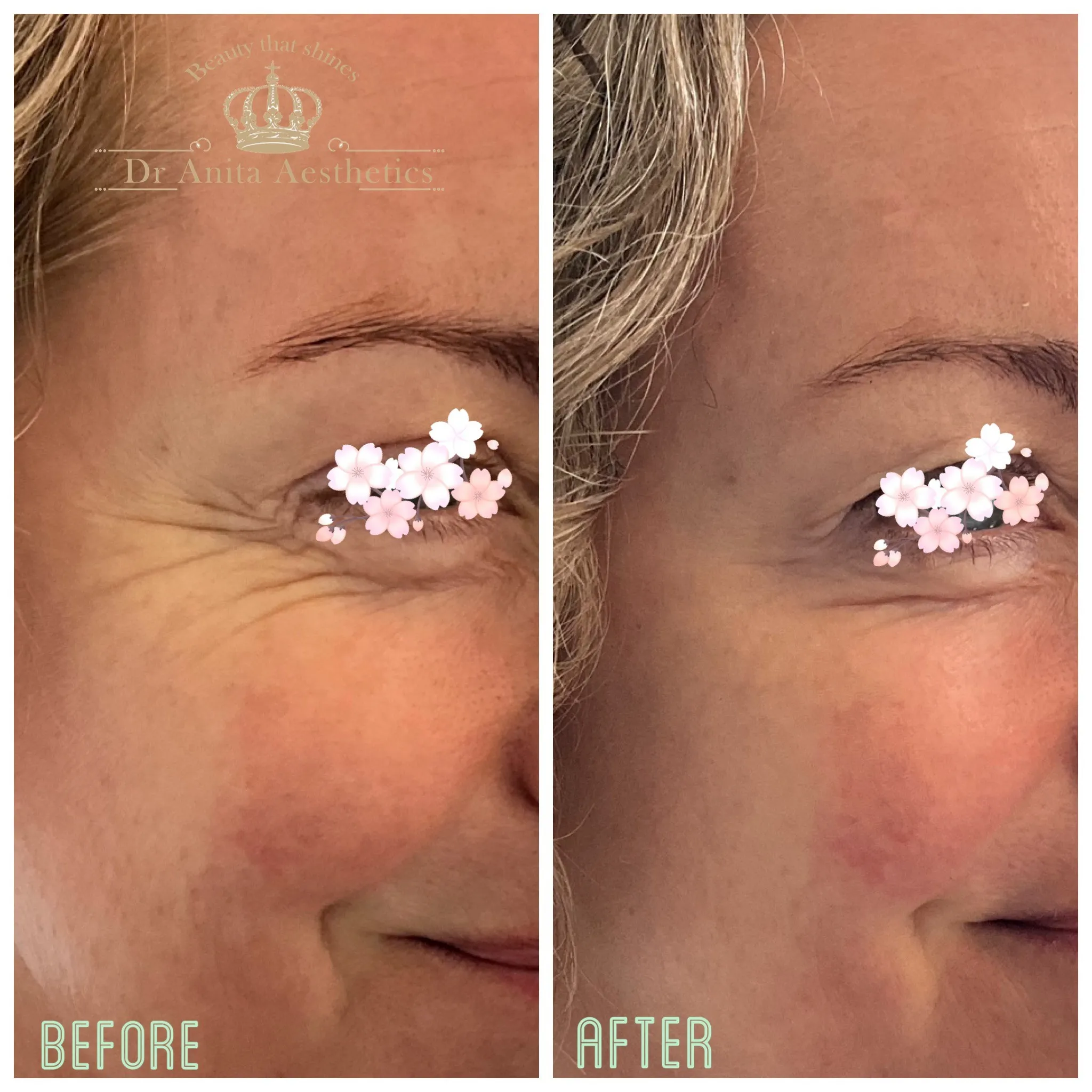botox-crows-feet