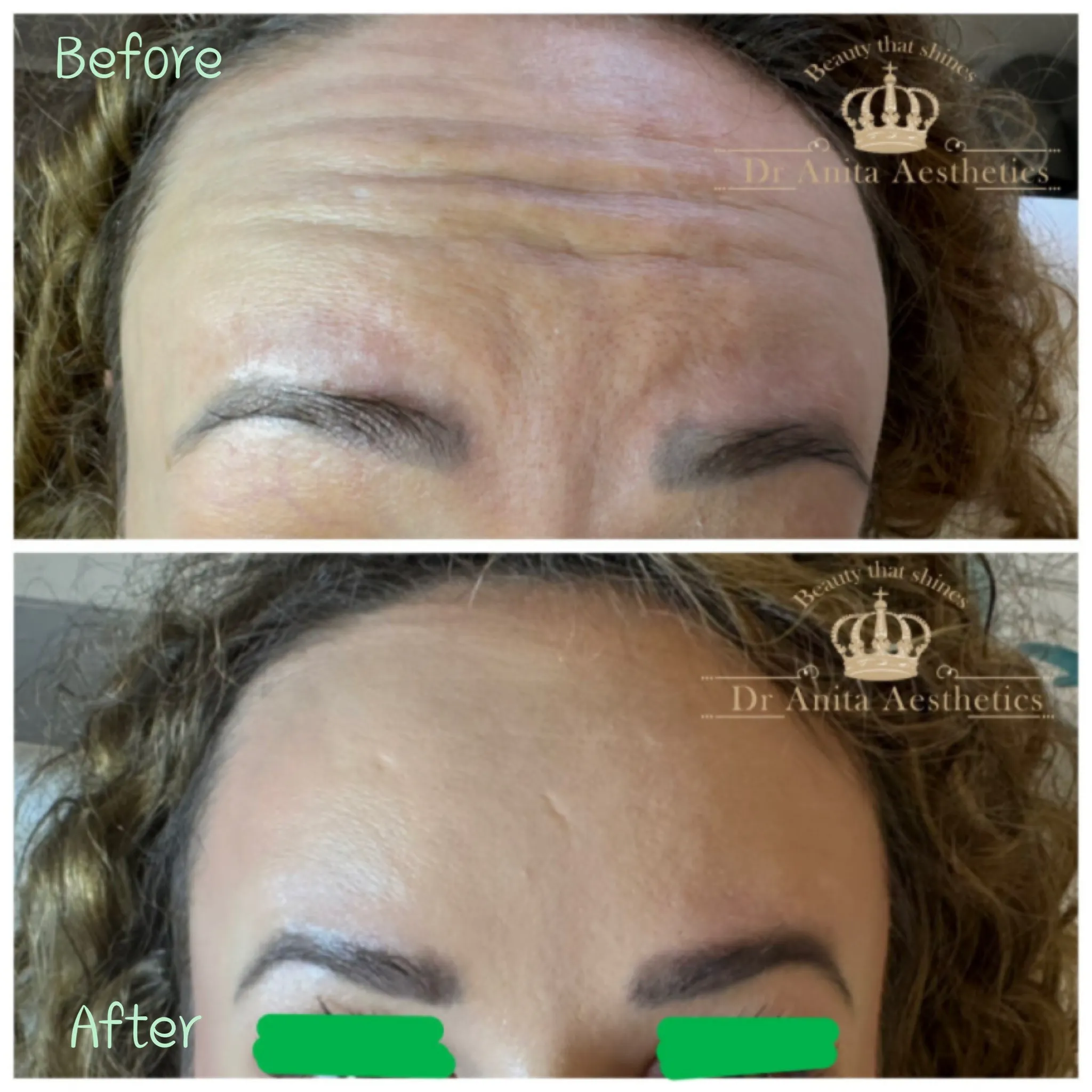 botox forehead