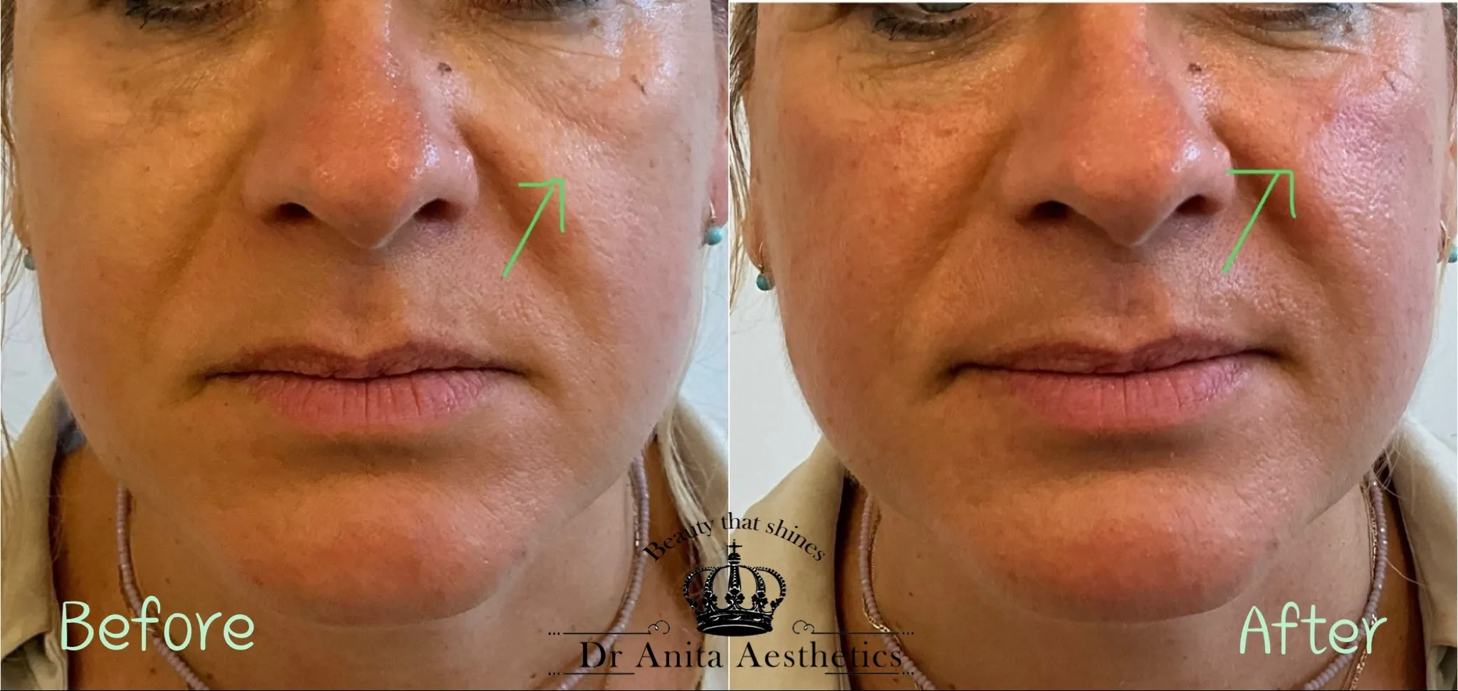 cheek augmentation