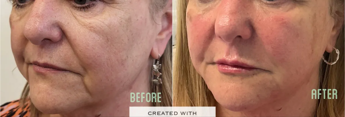 Before and after photos of a woman's face.