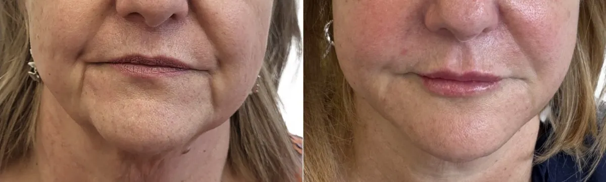 A woman's face before and after a lip lift.