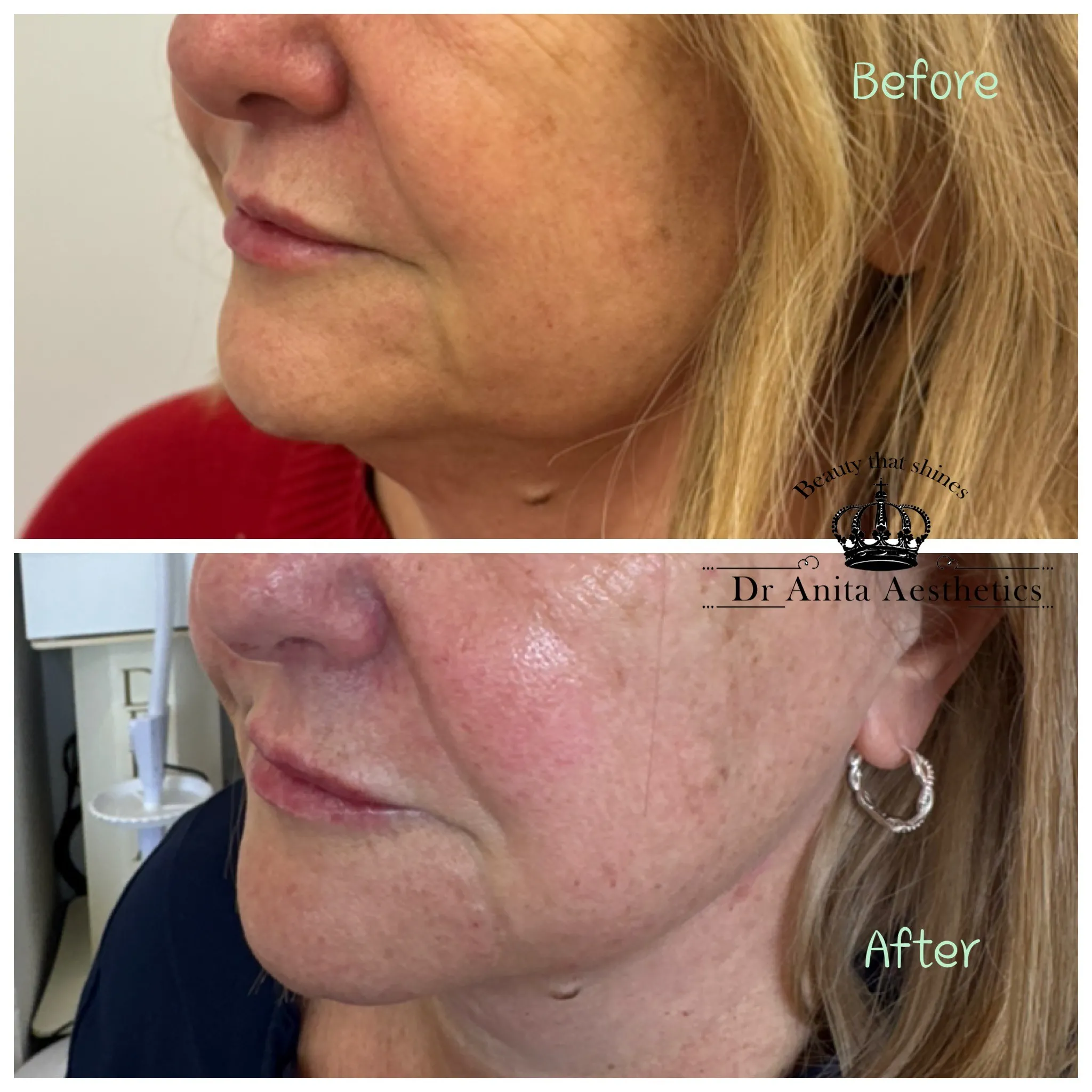 A before and after picture of a woman's face.