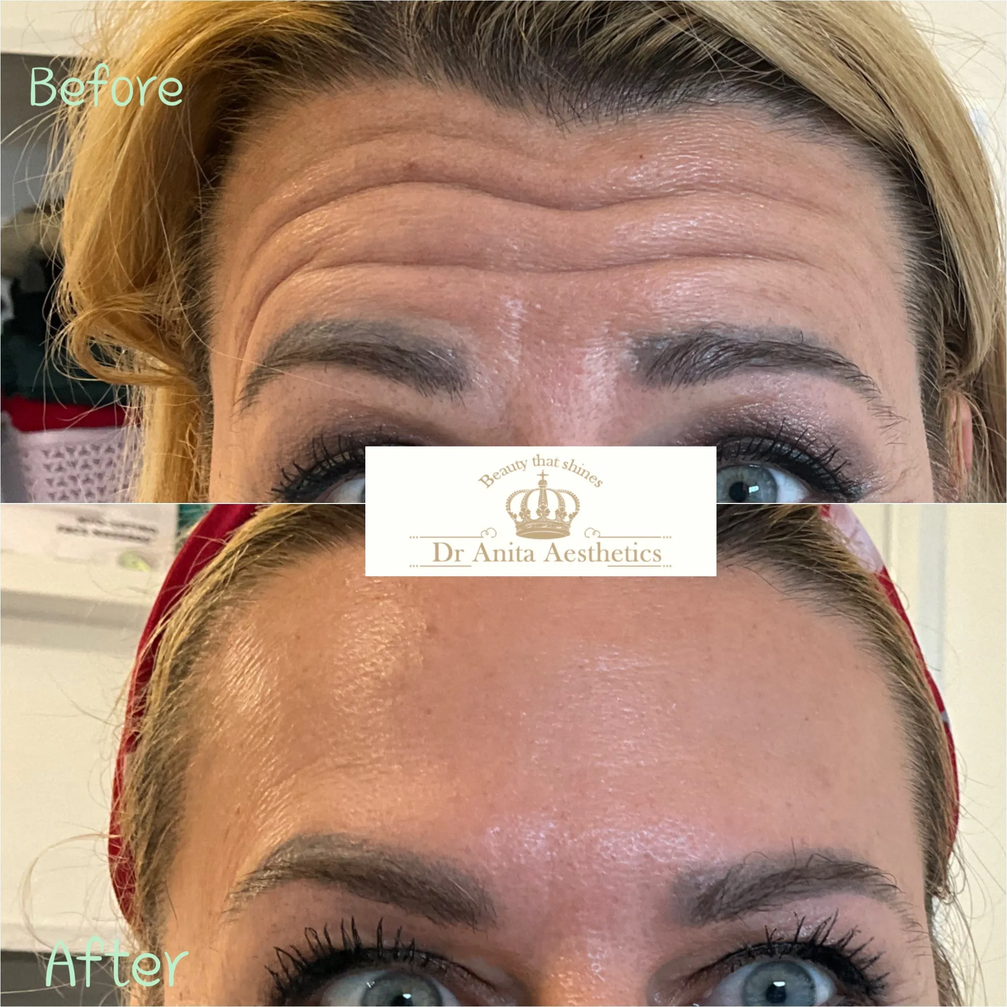 Before and after photos of a woman's eyebrows.