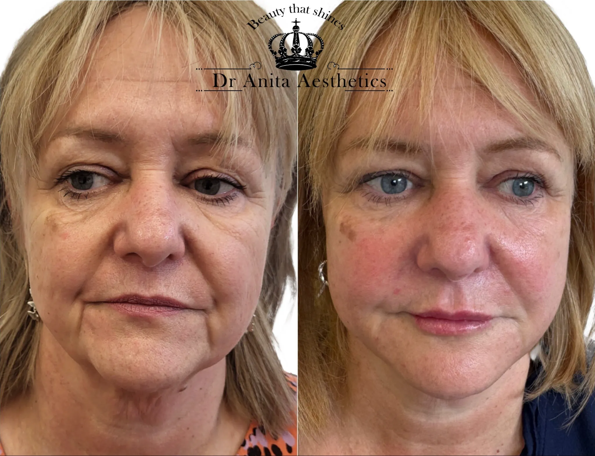 Before and after photos of a woman's face.