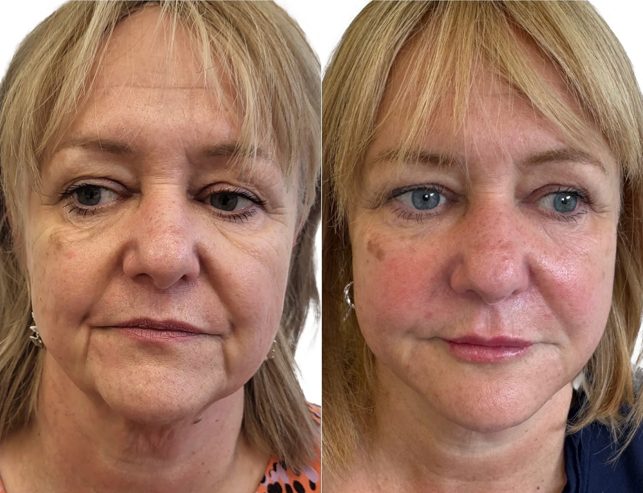 Full Face Rejuvenation