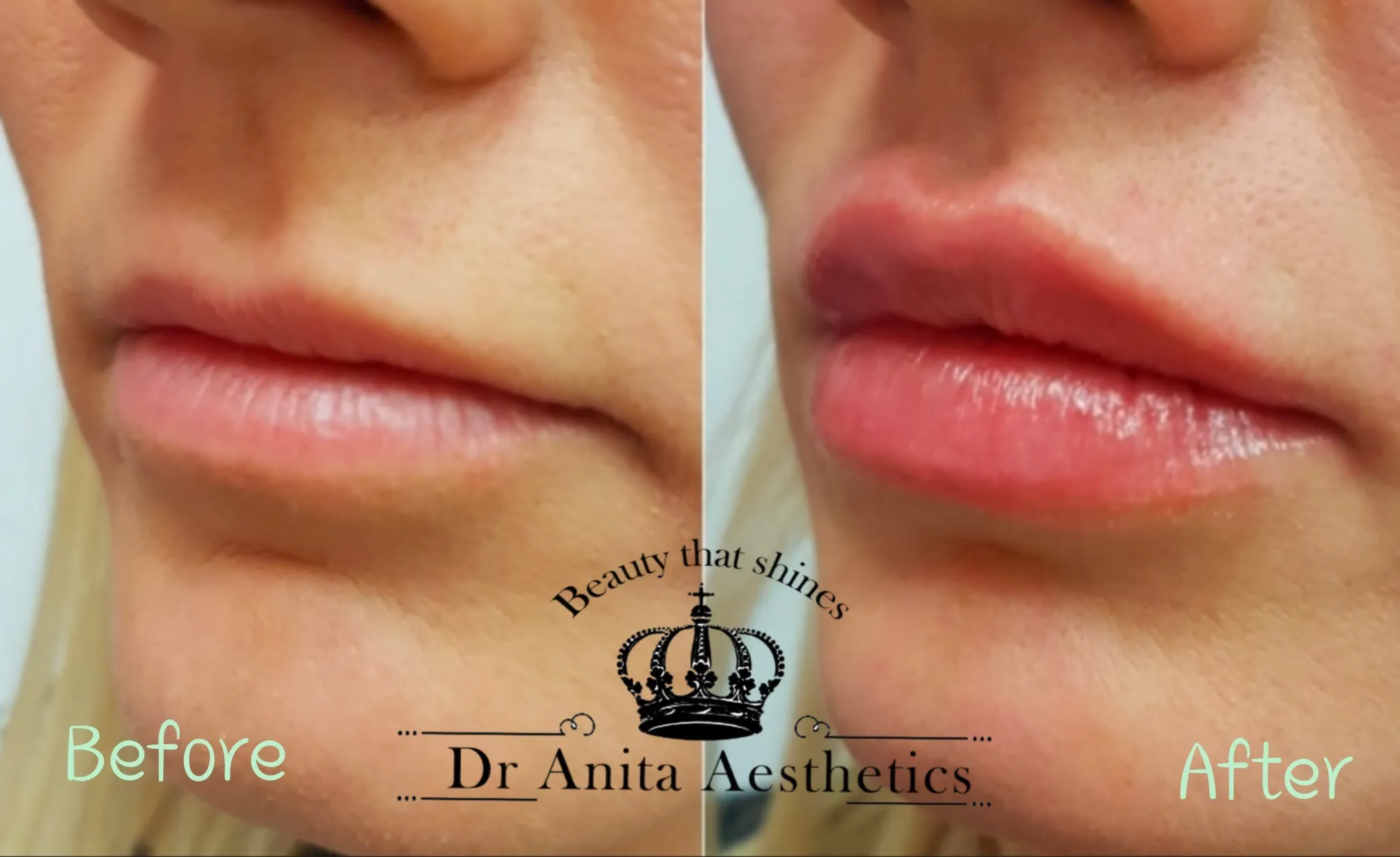lip enhancement