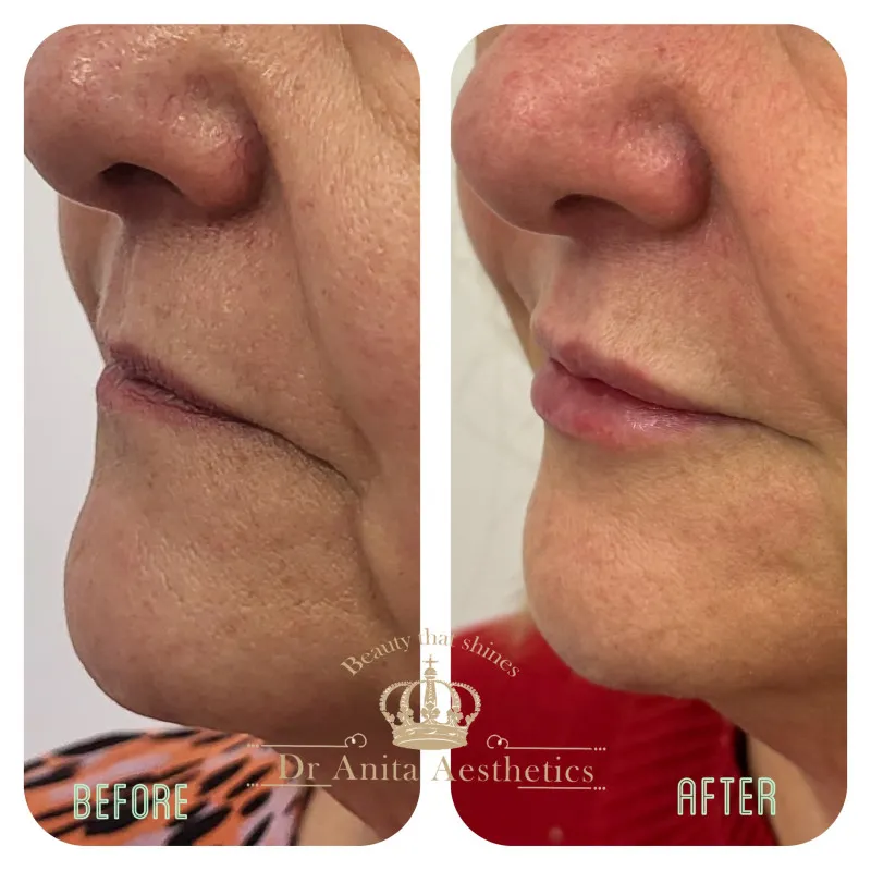 A before and after photo of a woman's face with lips enhanced.