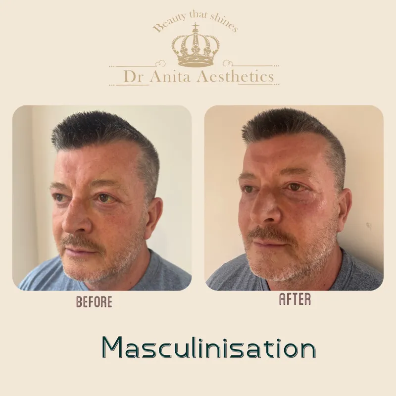 A before and after picture of a man's face after masculinisation.