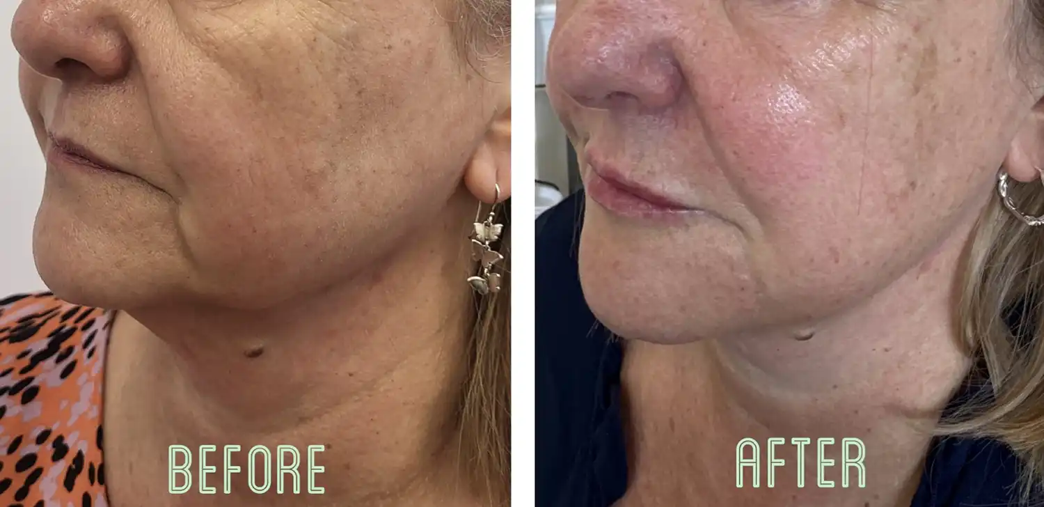 pre-jowl before and after