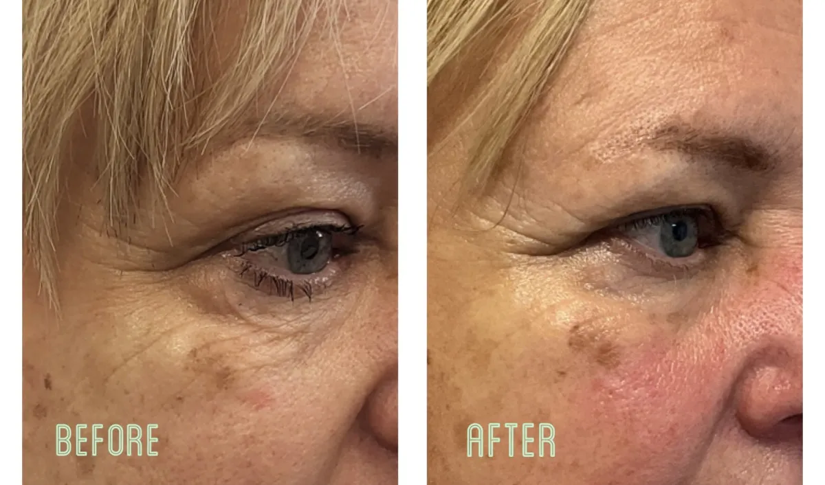 A before and after picture of a woman's eye.